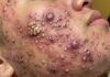 Cystic Acne Blackheads Extraction