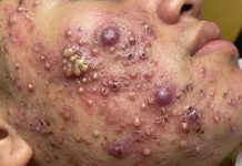Cystic Acne Blackheads Extraction