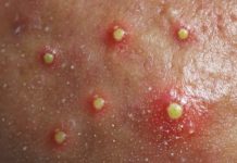 Cystic Blackheads Extraction Whiteheads