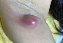Big Cystic Blackheads Extraction