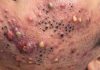 Cystic Acne Blackheads Extraction
