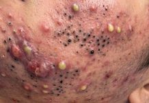 Cystic Acne Blackheads Extraction