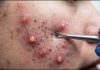 Blackheads Extraction Removal