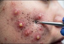 Blackheads Extraction Removal