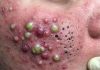Blackheads Extraction Whiteheads