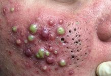 Blackheads Extraction Whiteheads