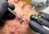 Blackheads Extraction Removal