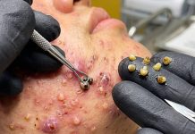 Blackheads Extraction Removal