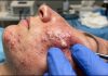 Big Cystic Acne Blackheads Extraction