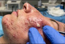 Big Cystic Acne Blackheads Extraction