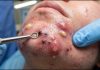 Blackheads Extraction Removal