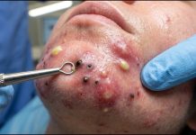 Blackheads Extraction Removal