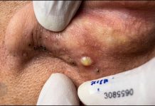 Cystic Extraction Whiteheads