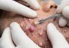Acne Blackheads Extraction Whiteheads