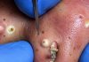 Blackheads Extraction Removal
