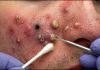 Blackheads Extraction Whiteheads