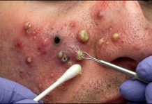 Blackheads Extraction Whiteheads