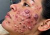 Acne Blackheads Extraction