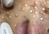 Acne Blackheads Extraction Whiteheads