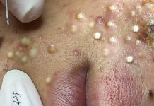 Acne Blackheads Extraction Whiteheads