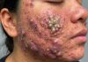 Acne Blackheads Whiteheads