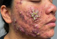 Acne Blackheads Whiteheads