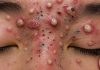 Blackheads Extraction Whiteheads