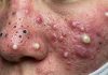 Cystic Blackheads Extraction Whiteheads