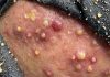 Blackheads Extraction Whiteheads