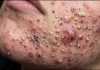 Cystic Acne Blackheads Extraction