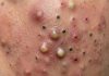 Cystic Acne Extraction Whiteheads