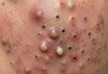 Cystic Acne Extraction Whiteheads