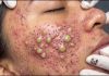 Acne Blackheads Extraction Whiteheads