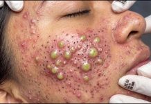 Acne Blackheads Extraction Whiteheads