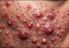 Cystic Acne Blackheads Extraction Whiteheads