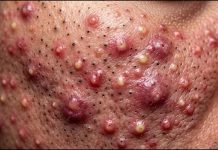 Cystic Acne Blackheads Extraction Whiteheads