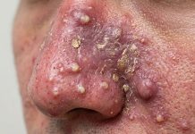 Cystic Blackheads Extraction