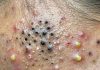 Blackheads Extraction