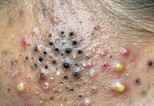 Blackheads Extraction