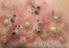 Blackheads Extraction Whiteheads