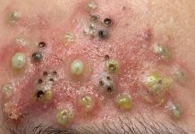 Blackheads Extraction Whiteheads