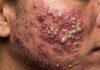 Cystic Acne Blackheads Extraction