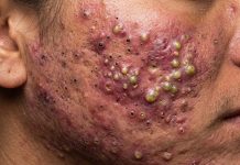 Cystic Acne Blackheads Extraction