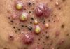 Big Cystic Blackheads Extraction
