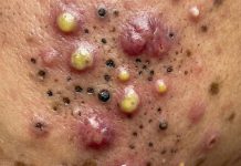 Big Cystic Blackheads Extraction