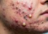 Cystic Blackheads Extraction Whiteheads