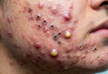 Cystic Blackheads Extraction Whiteheads