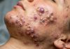Acne Blackheads Extraction