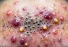 Blackheads Extraction