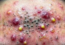 Blackheads Extraction